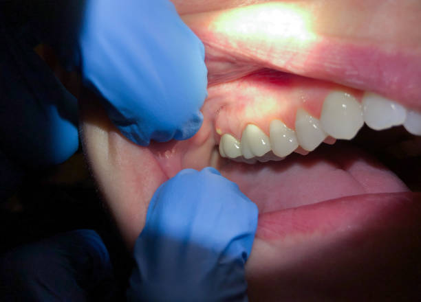 Best Emergency Tooth Extraction in Forest, OH
